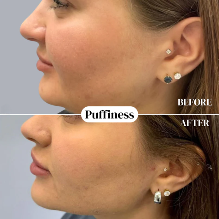 Lymphatic Drainage at 10% The Cost